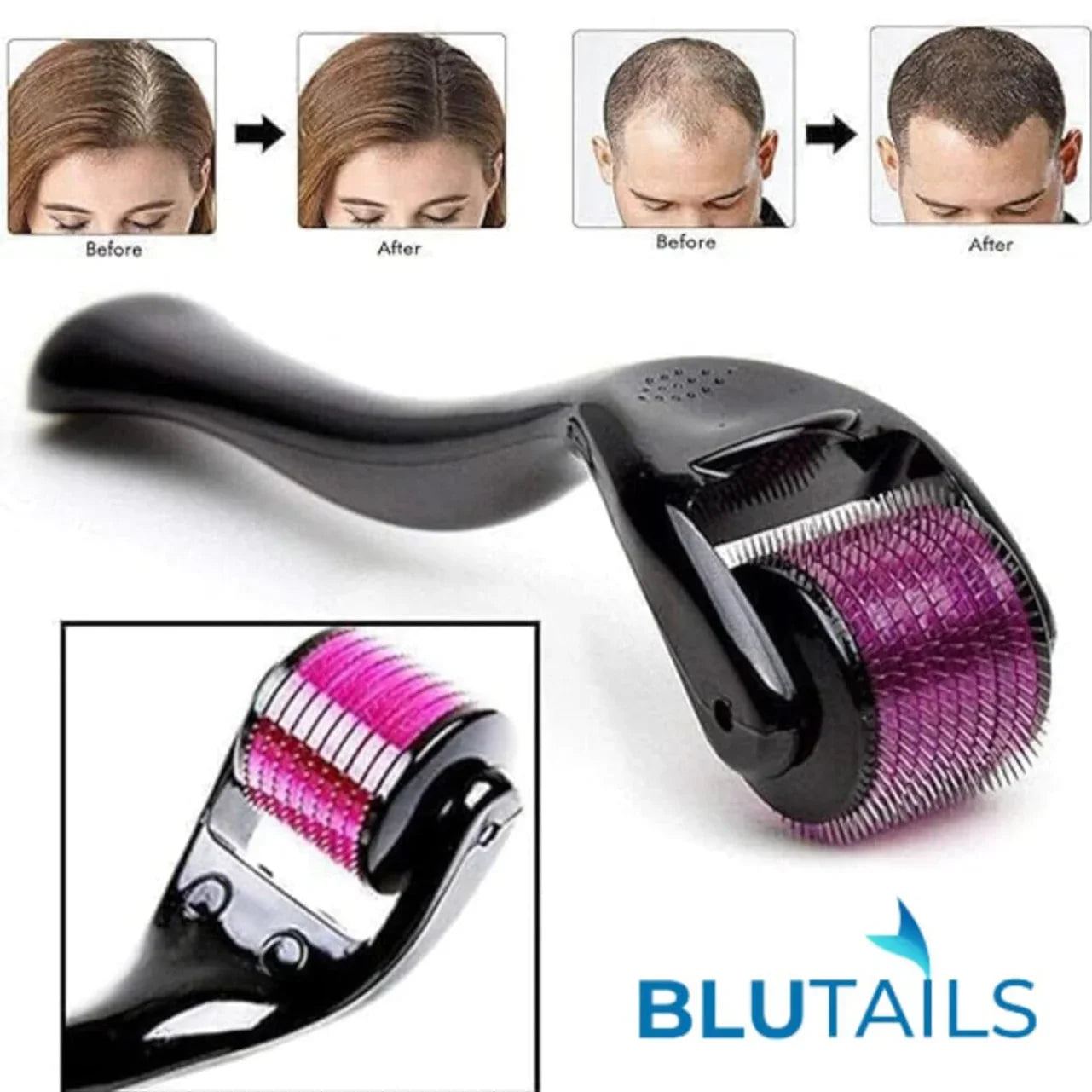 Titanium Facial Dermaroller 0.5 mm | Microneedling for Radiant Skin - shovota